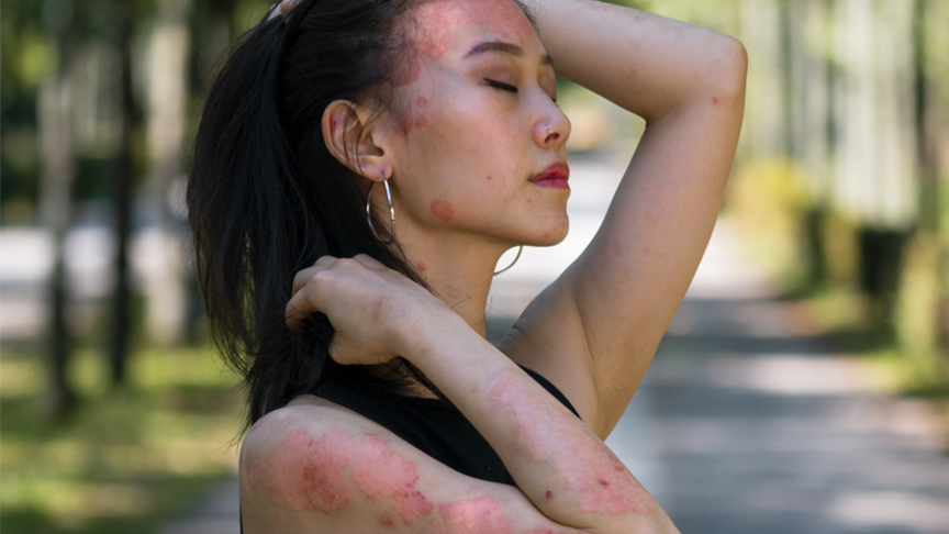Embracing the Unseen Drivers of Psoriasis